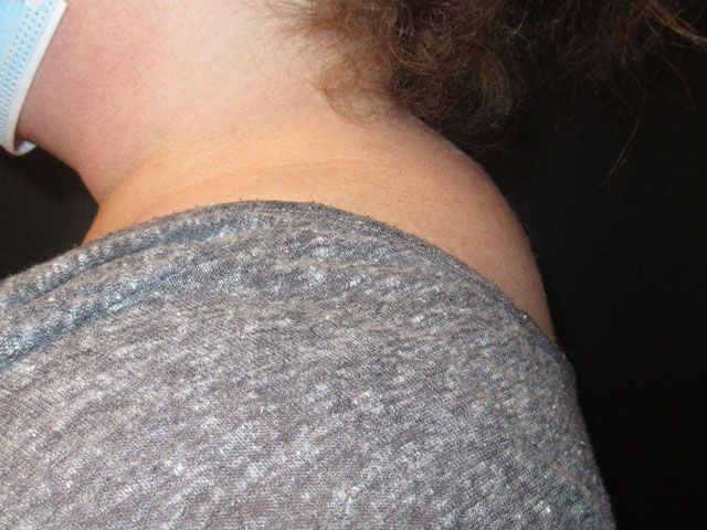 Liposuction Before & After