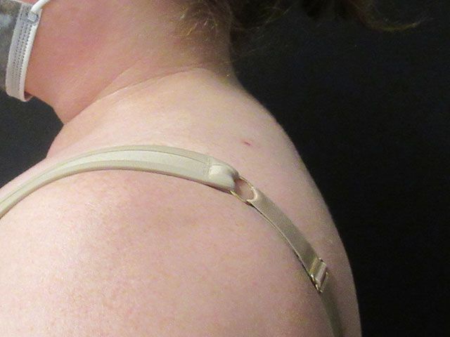 Liposuction Before & After