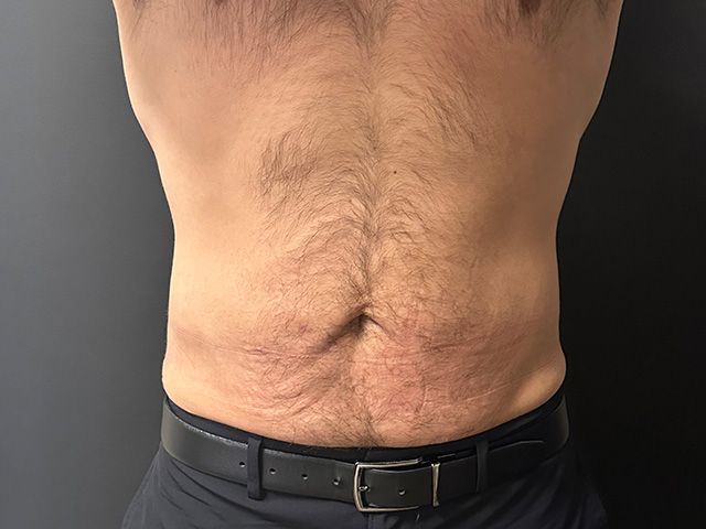 Body Contouring Package Before & After