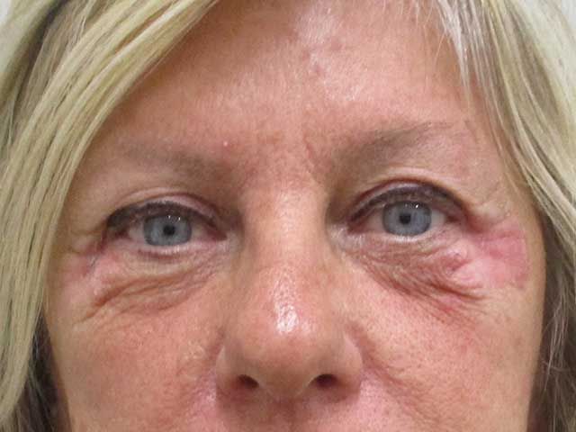 Blepharoplasty Before & After