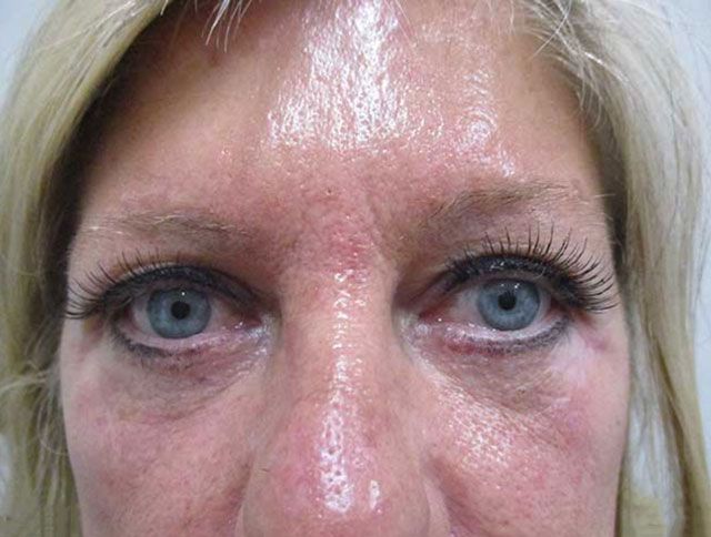 Blepharoplasty Before & After