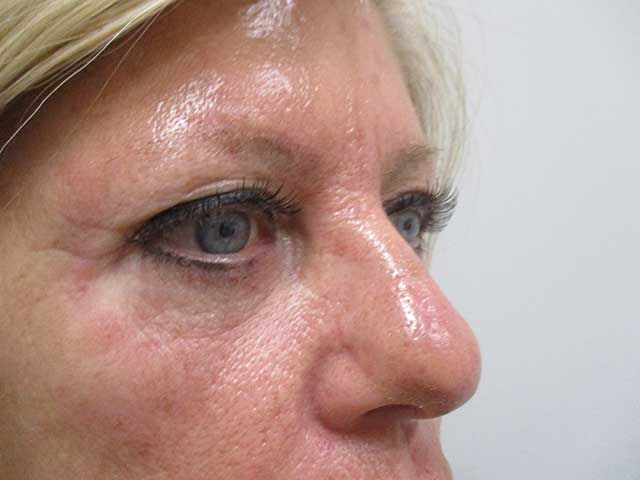 Blepharoplasty Before & After