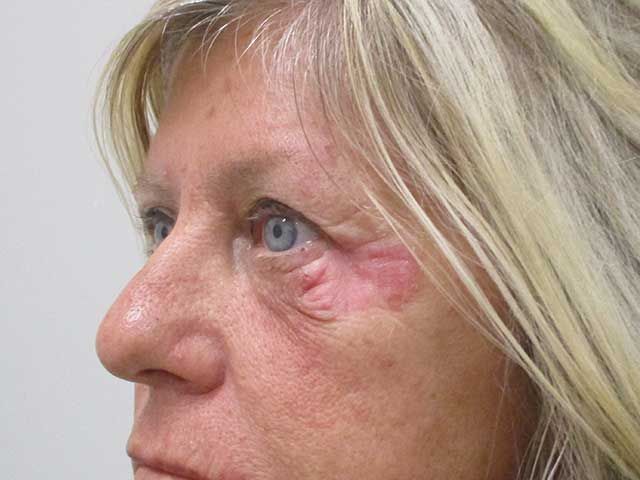 Blepharoplasty Before & After