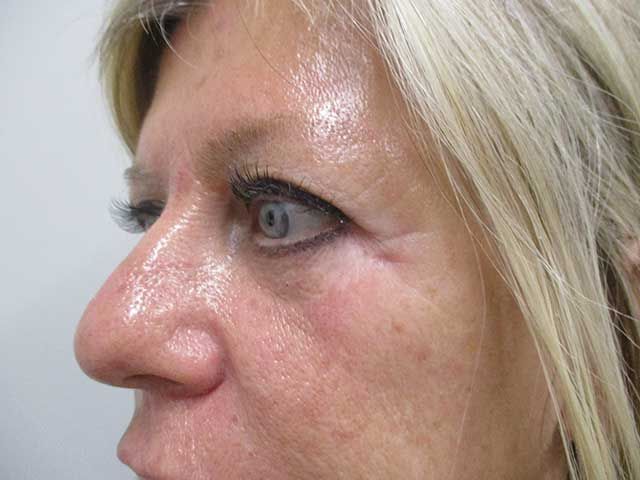 Blepharoplasty Before & After