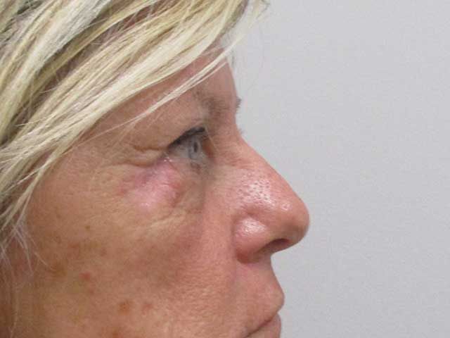Blepharoplasty Before & After