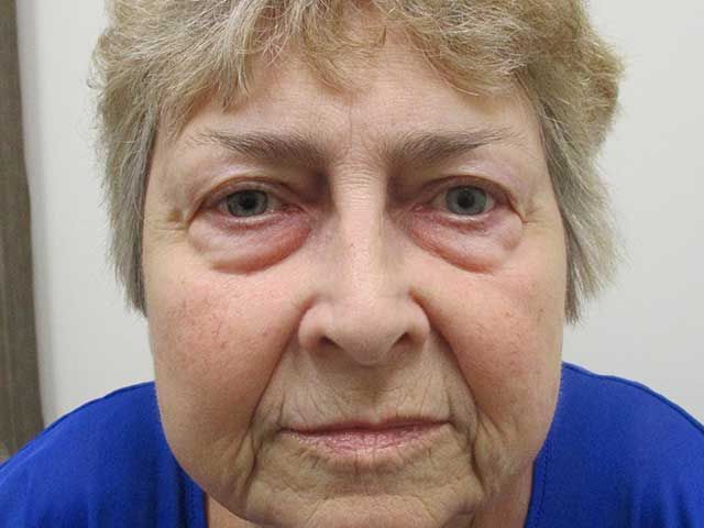 Blepharoplasty Before & After