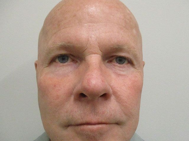 Blepharoplasty Before & After