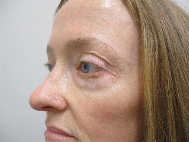 Blepharoplasty Before & After