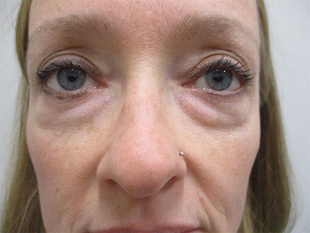 Blepharoplasty Before & After