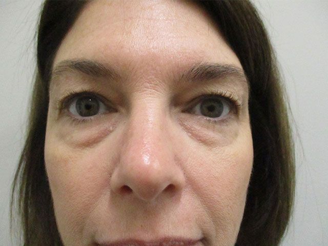 Blepharoplasty Before & After
