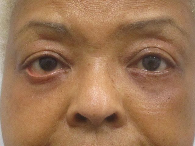 Blepharoplasty Before & After