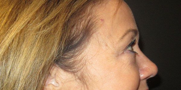 Blepharoplasty Before & After