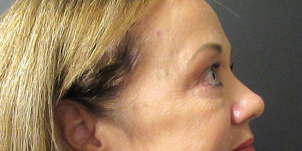 Blepharoplasty Before & After