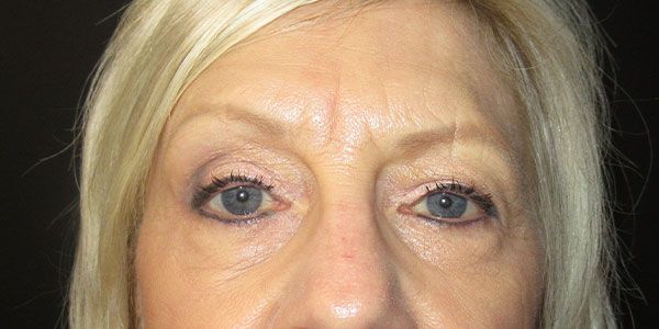 Blepharoplasty Before & After