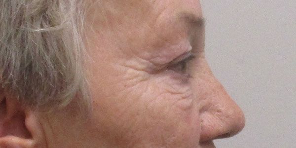 Blepharoplasty Before & After