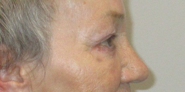 Blepharoplasty Before & After