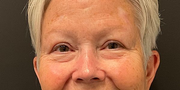 Blepharoplasty Before & After