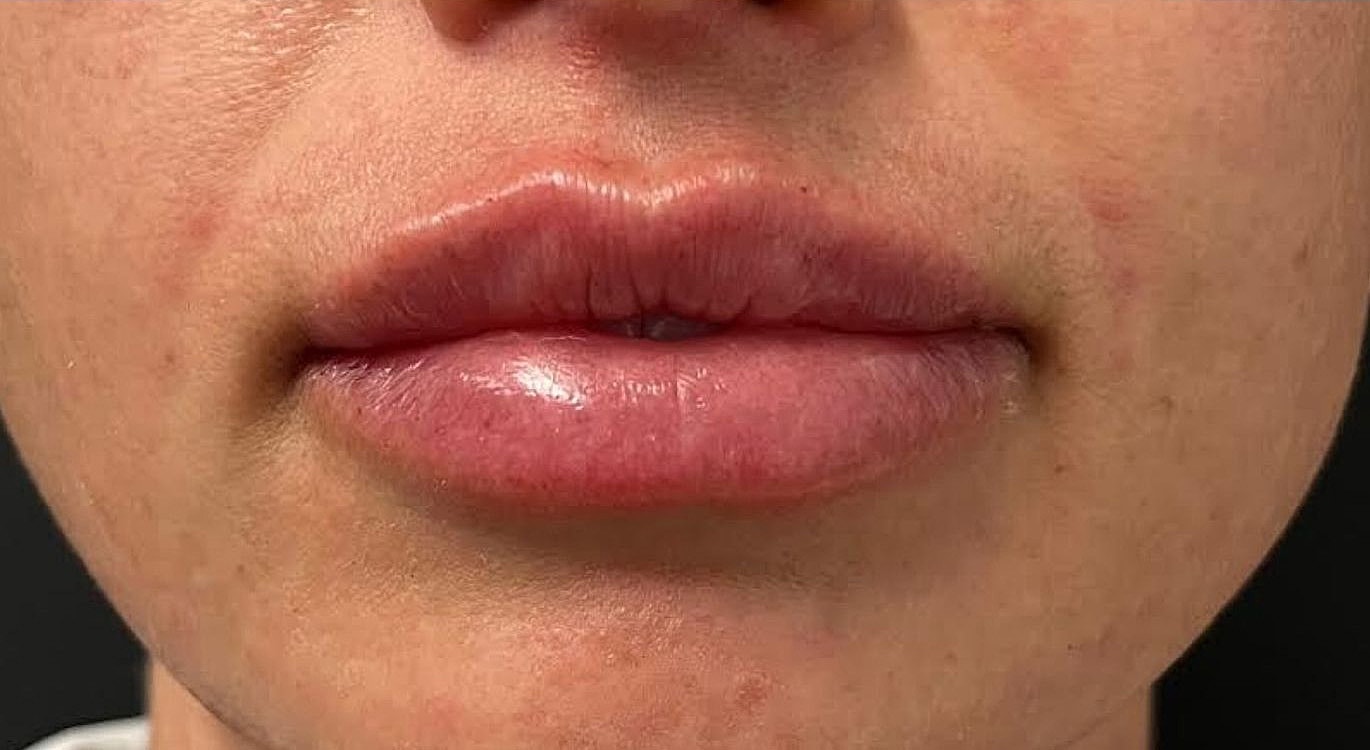 Lips Before & After