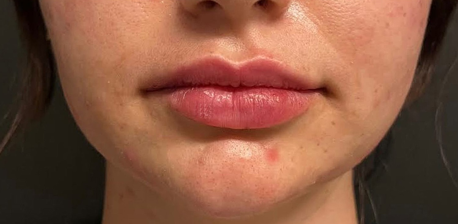 Lips Before & After