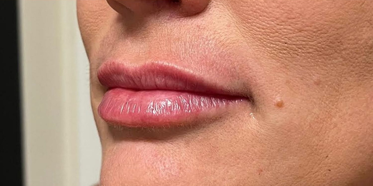 Lips Before & After