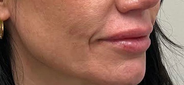 Lips Before & After