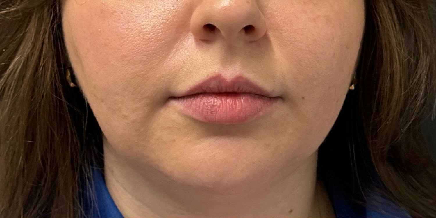 Lips Before & After