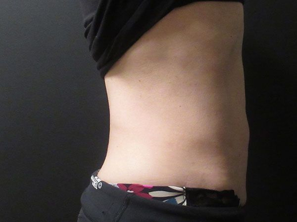 Emsculpt Neo Before & After