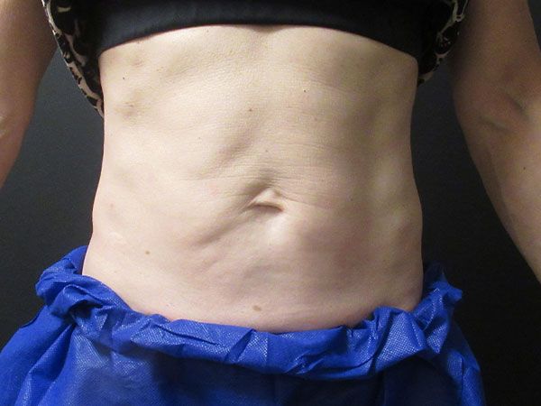 Emsculpt Neo Before & After