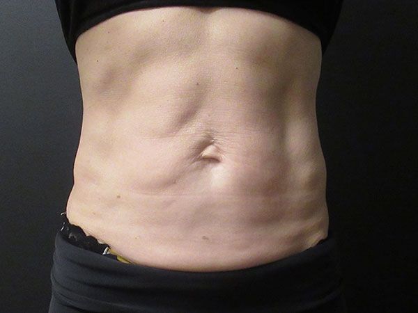 Emsculpt Neo Before & After