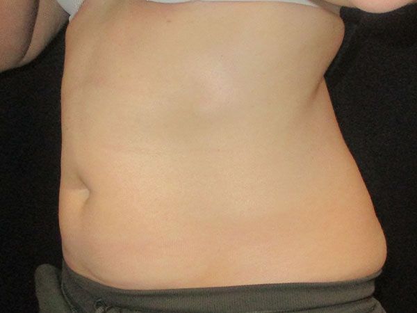 Emsculpt Neo Before & After