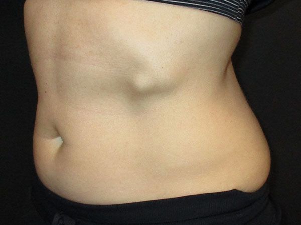 Emsculpt Neo Before & After