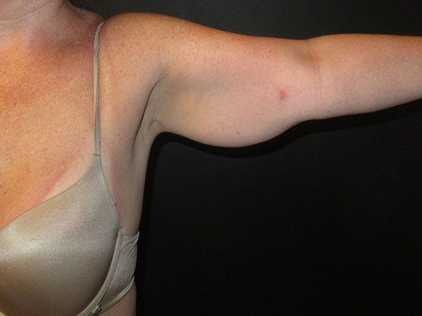 Emsculpt Neo Before & After