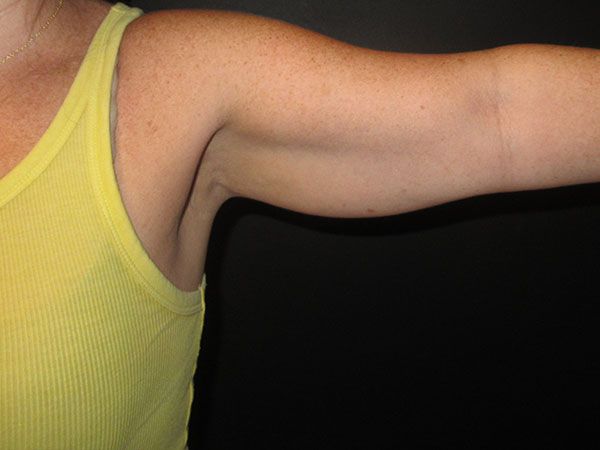 Emsculpt Neo Before & After