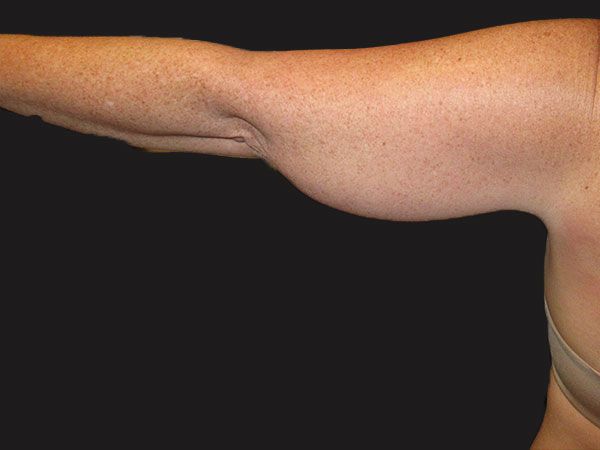 Emsculpt Neo Before & After