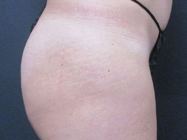 Emsculpt Neo Before & After