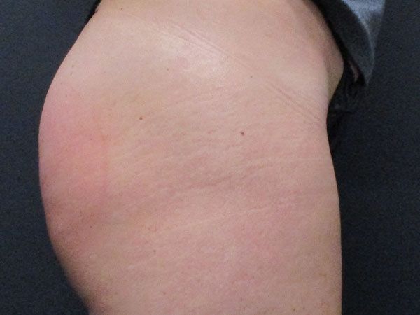 Emsculpt Neo Before & After