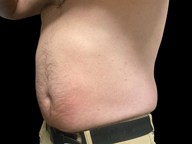 Emsculpt Neo Before & After