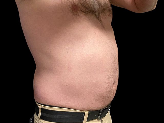 Emsculpt Neo Before & After