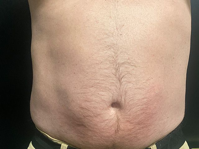 Emsculpt Neo Before & After