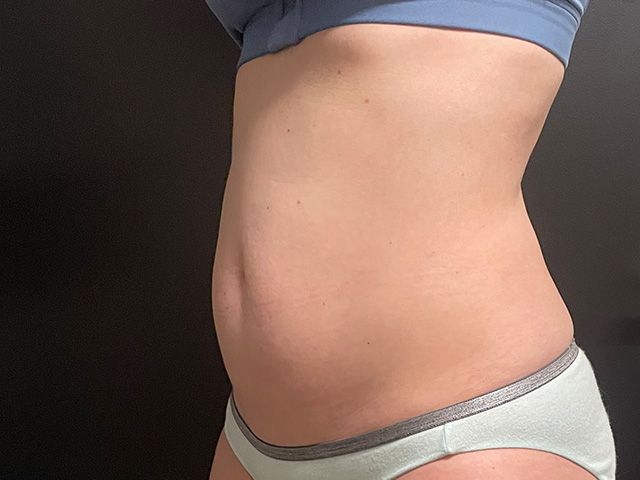 Emsculpt Neo Before & After