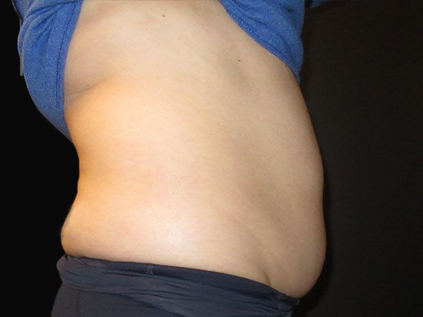 Emsculpt Neo Before & After