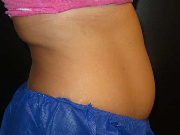 Emsculpt Neo Before & After