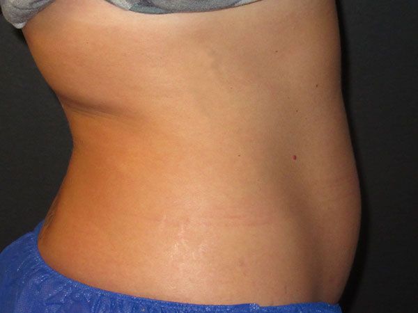 Emsculpt Neo Before & After