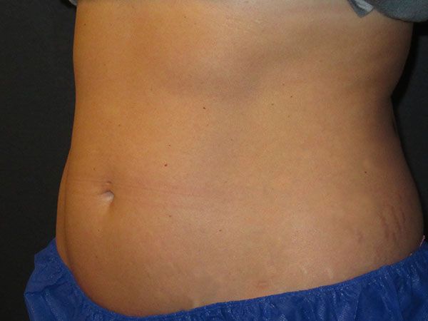 Emsculpt Neo Before & After