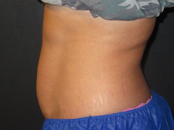 Emsculpt Neo Before & After