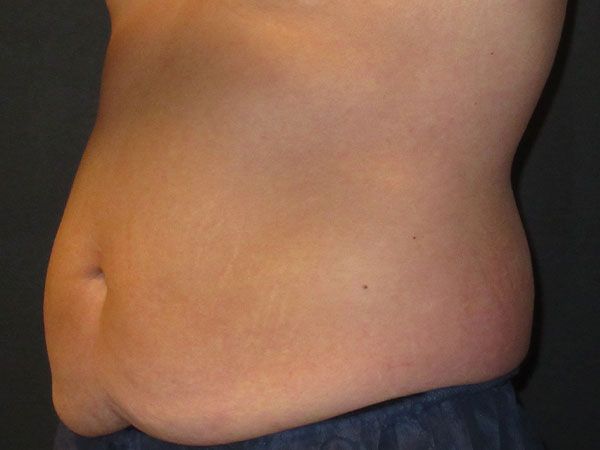 Emsculpt Neo Before & After