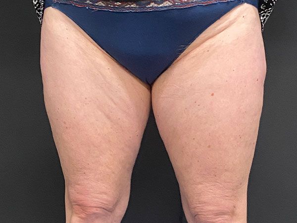 Emsculpt Neo Before & After