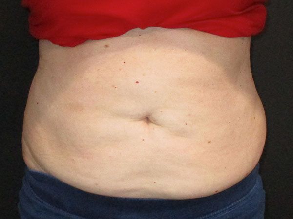 Emsculpt Neo Before & After