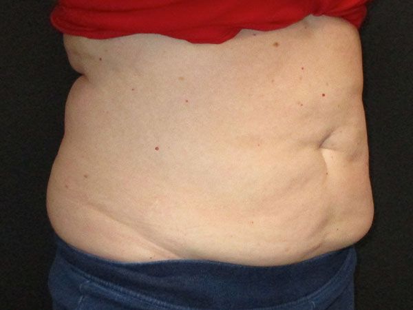 Emsculpt Neo Before & After