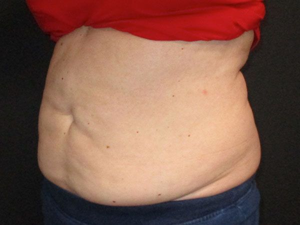 Emsculpt Neo Before & After